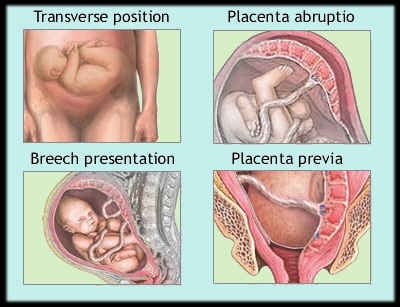 imagini placenta praevia